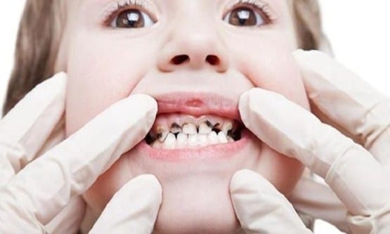 كيف تتجنب تسوس الأسنان وما الوقت المناسب للذهاب إلى الطبيب