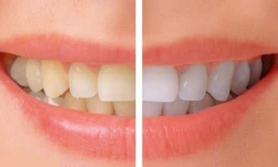 كيف تتخلص من صفار الأسنان نهائيًا بوصفات منزلية سهلة وبسيطة